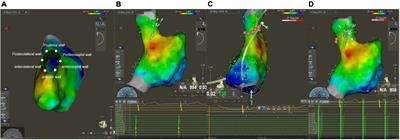 Ablation index-guided high-power ablation for superior vena cava isolation in patients with atrial fibrillation